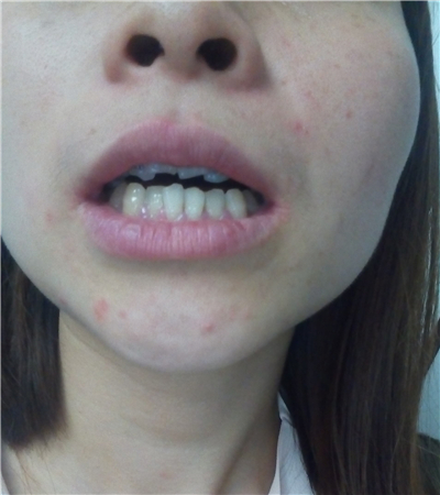 成都圣貝口腔翟永森做的牙齒矯正，分享果照片~